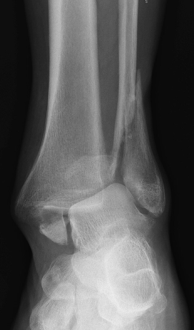 Ankle fracture, X-ray