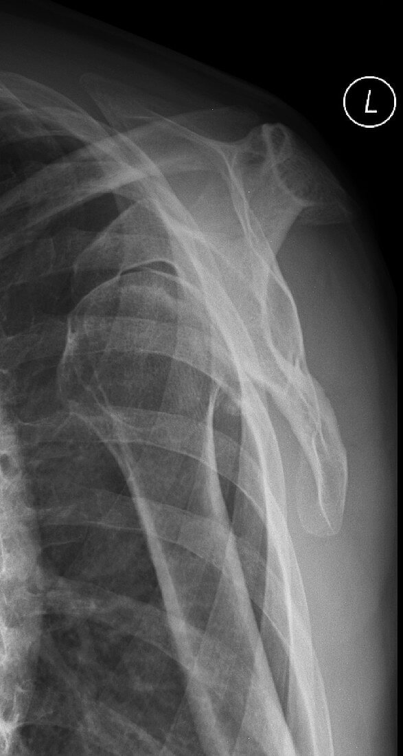 Anterior glenohumeral subluxation, X-ray