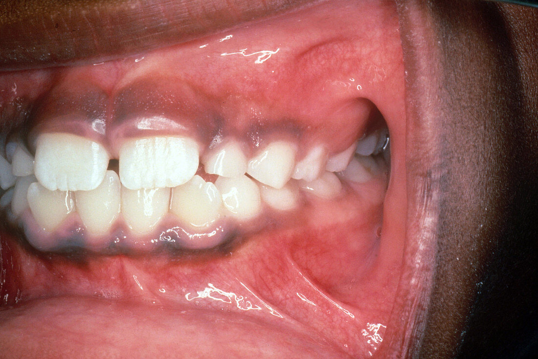 Mix of Permanent and Primary Teeth