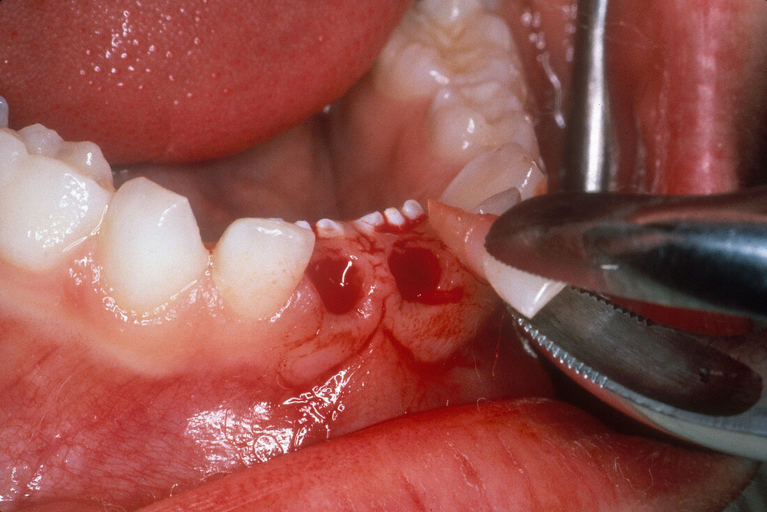 Over-Retained Primary Teeth Removed