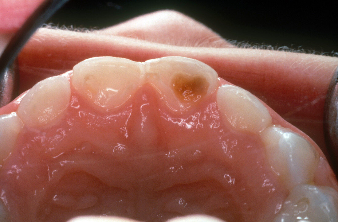 Baby Bottle Tooth Decay