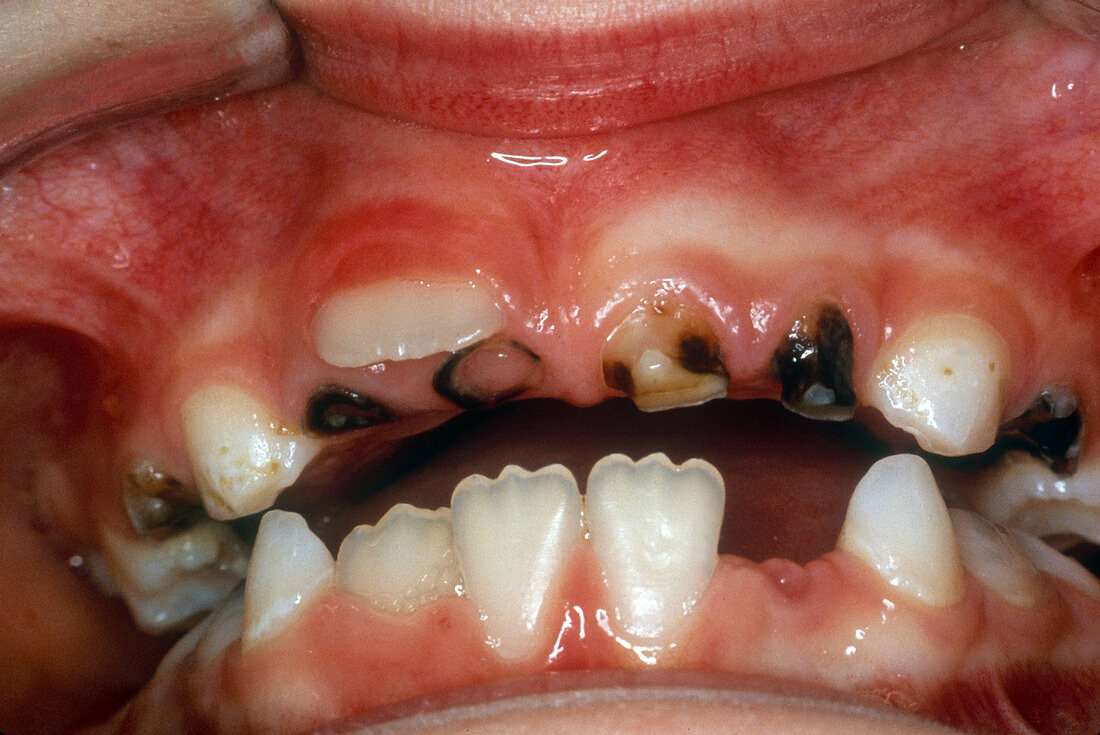 Severe Tooth Decay in Child