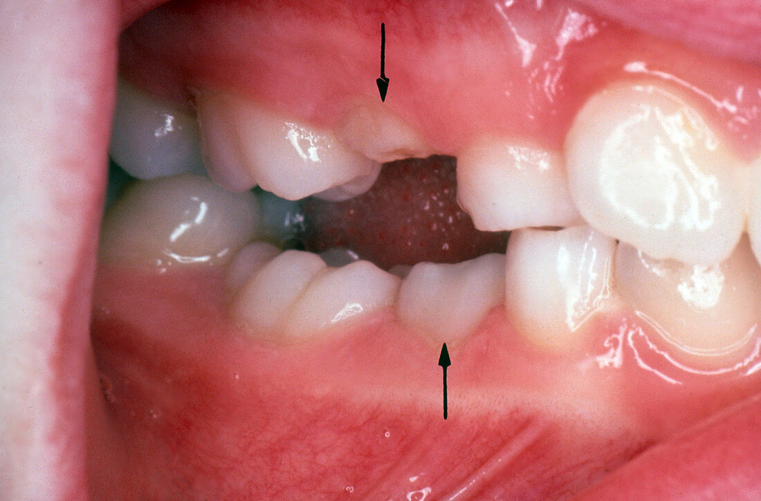 Ankylosis