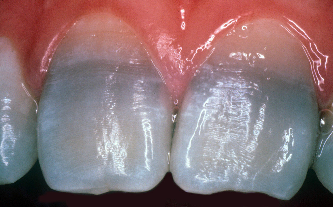 Teeth Stained from Tetracycline