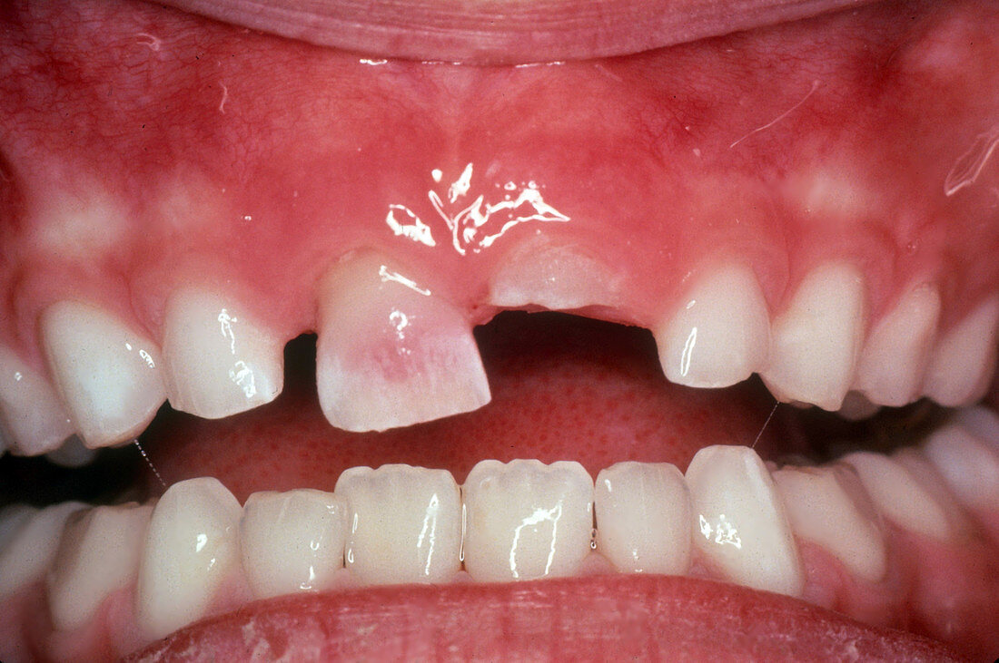 Pink Discolouration of Primary Tooth