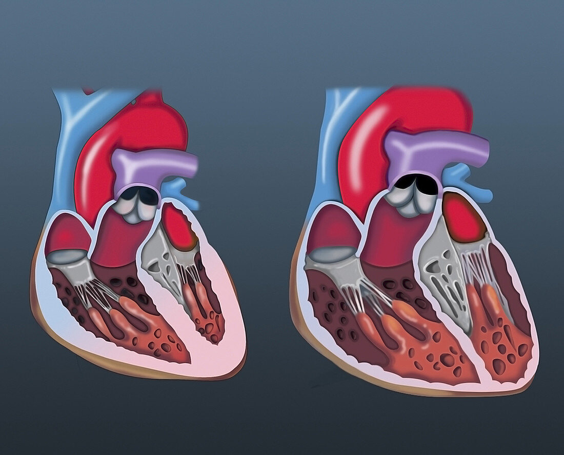 Dilated cardiomyopathy vs. normal heart, illustration