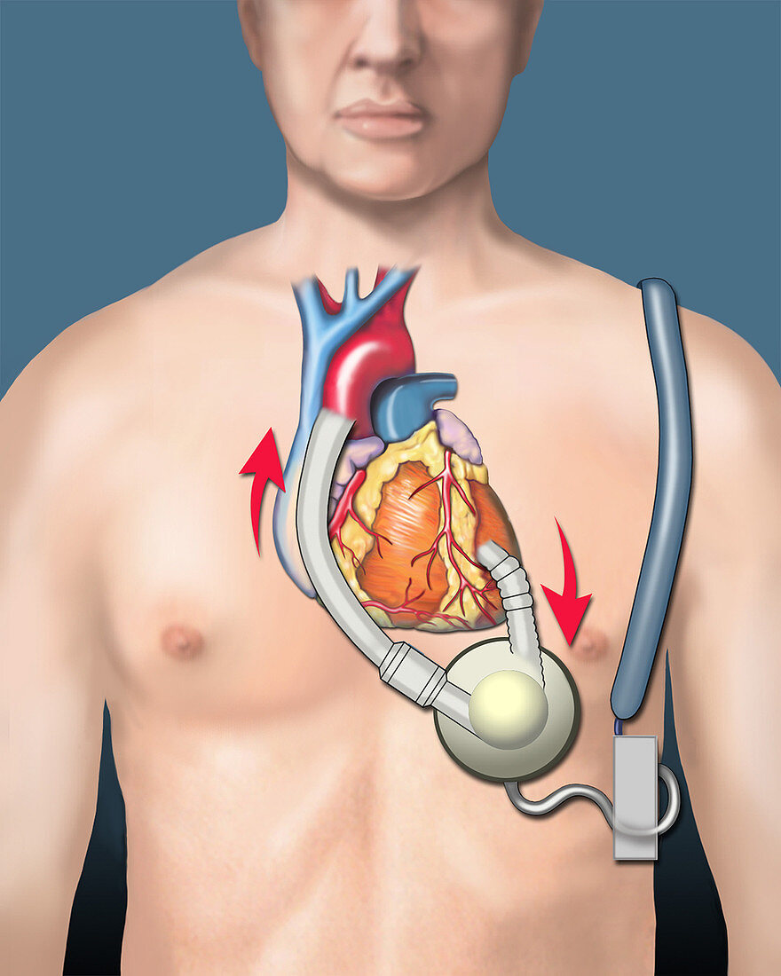 Ventricular Assist Device, illustration