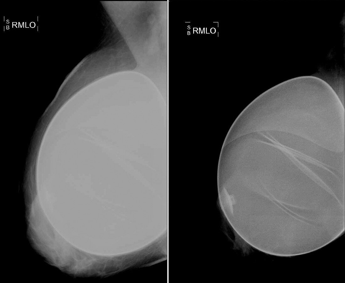 Mammogram of patient with implants