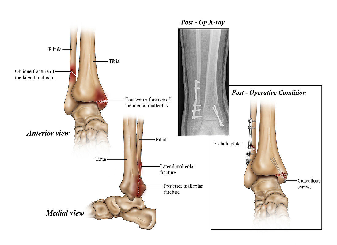 Lateral, Medial and Posterior Malleolar Fracture