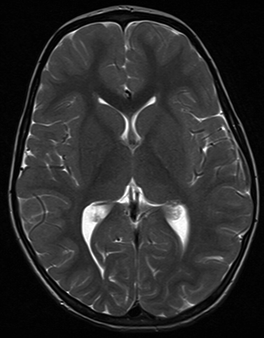 Brain of a 2 year old, normal MRI