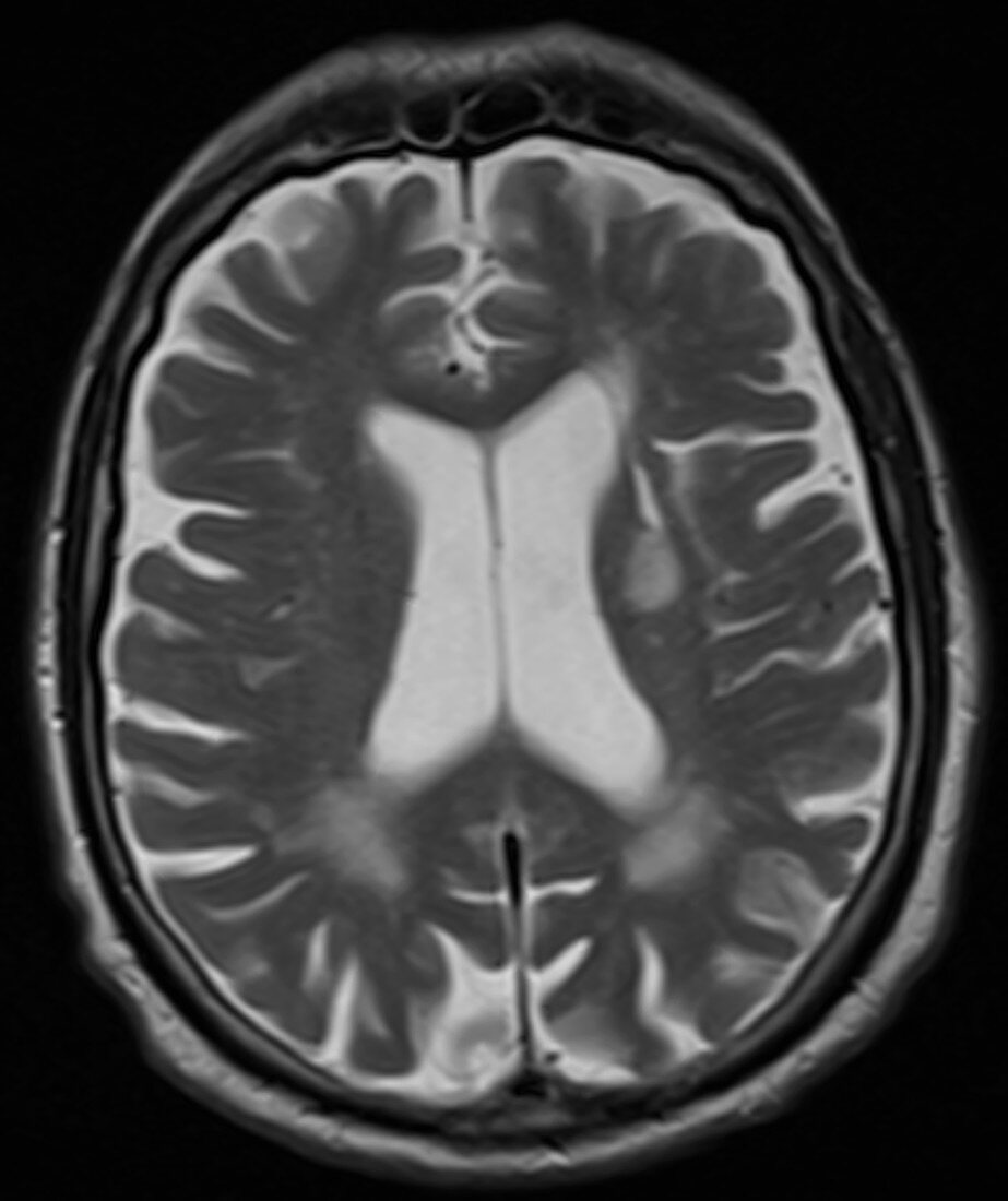 Acute stroke, MRI