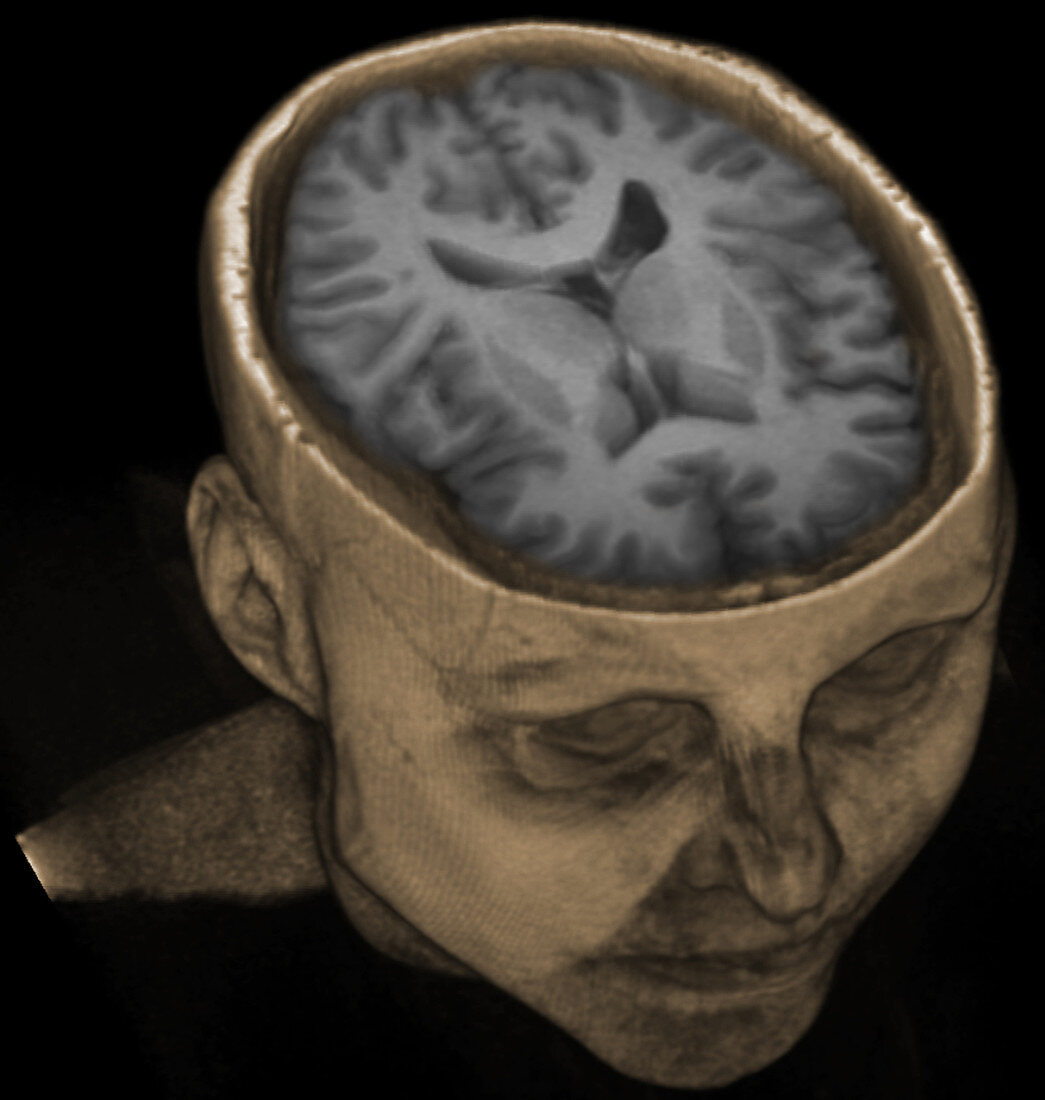 Normal brain, 3D MRI