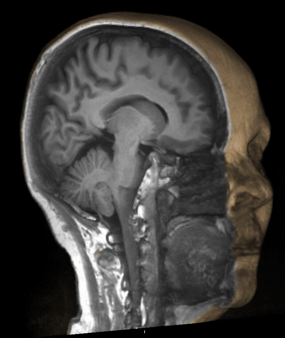 Normal brain, 3D MRI