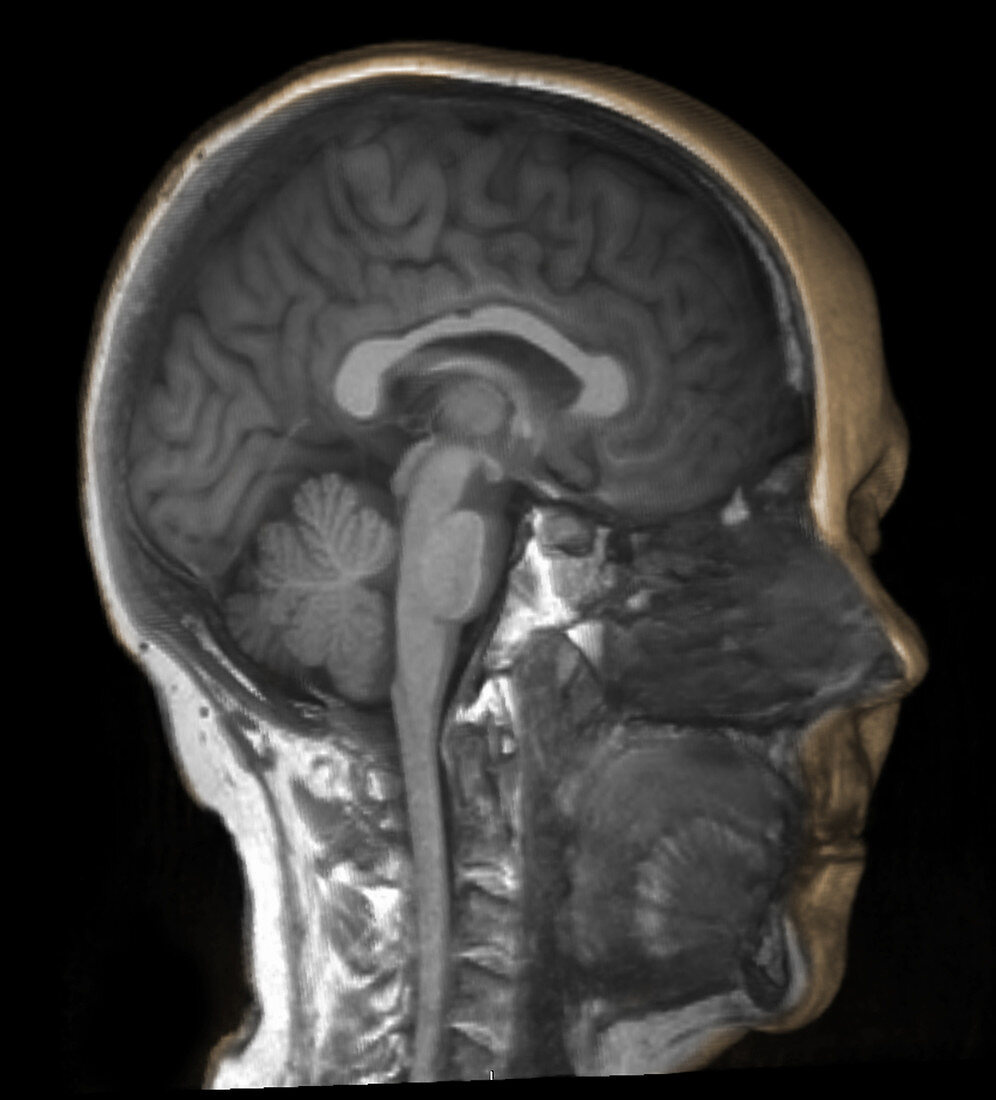 Normal brain, 3D MRI
