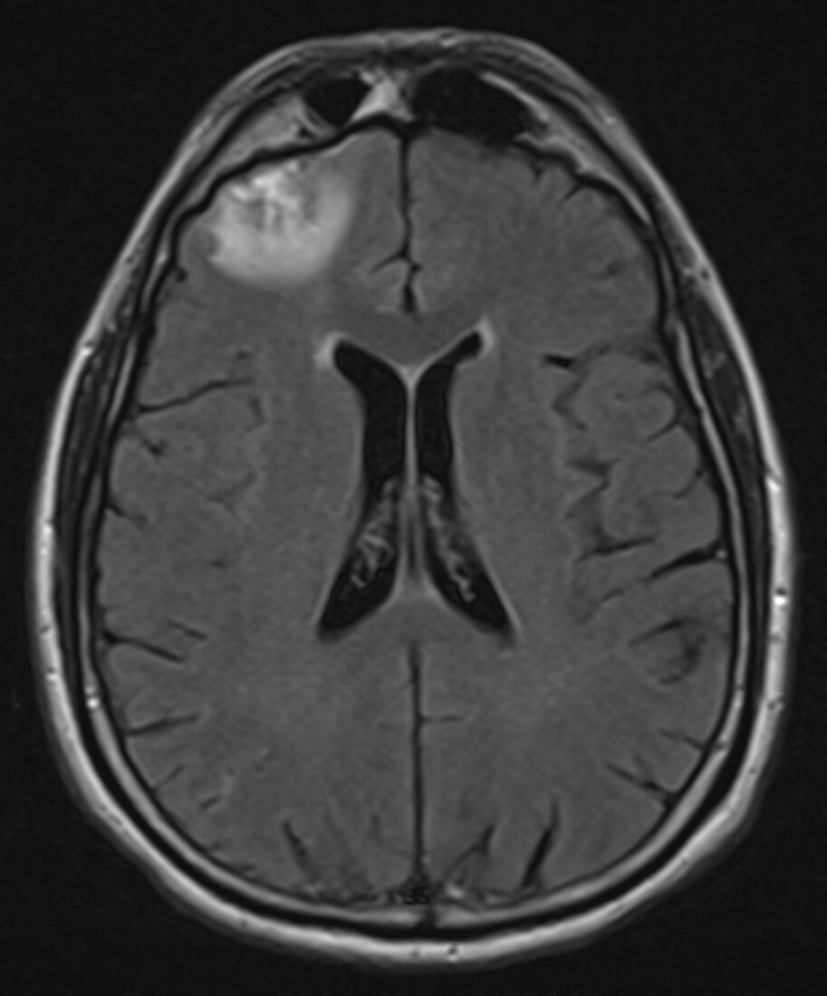 Brain Contusion, MRI