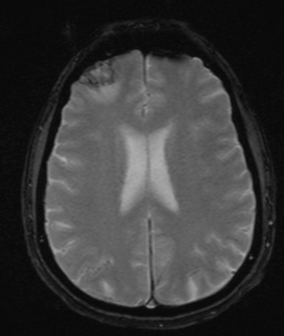Brain Contusion, MRI
