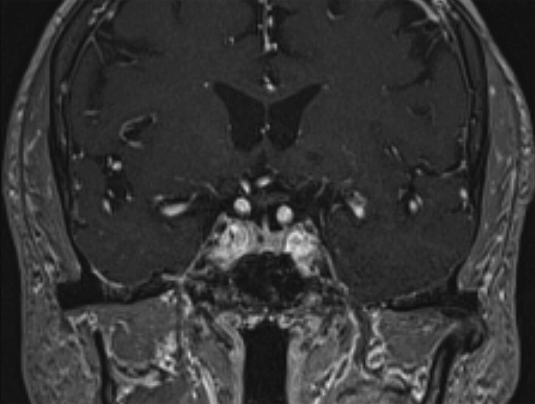 Microadenoma, MRI