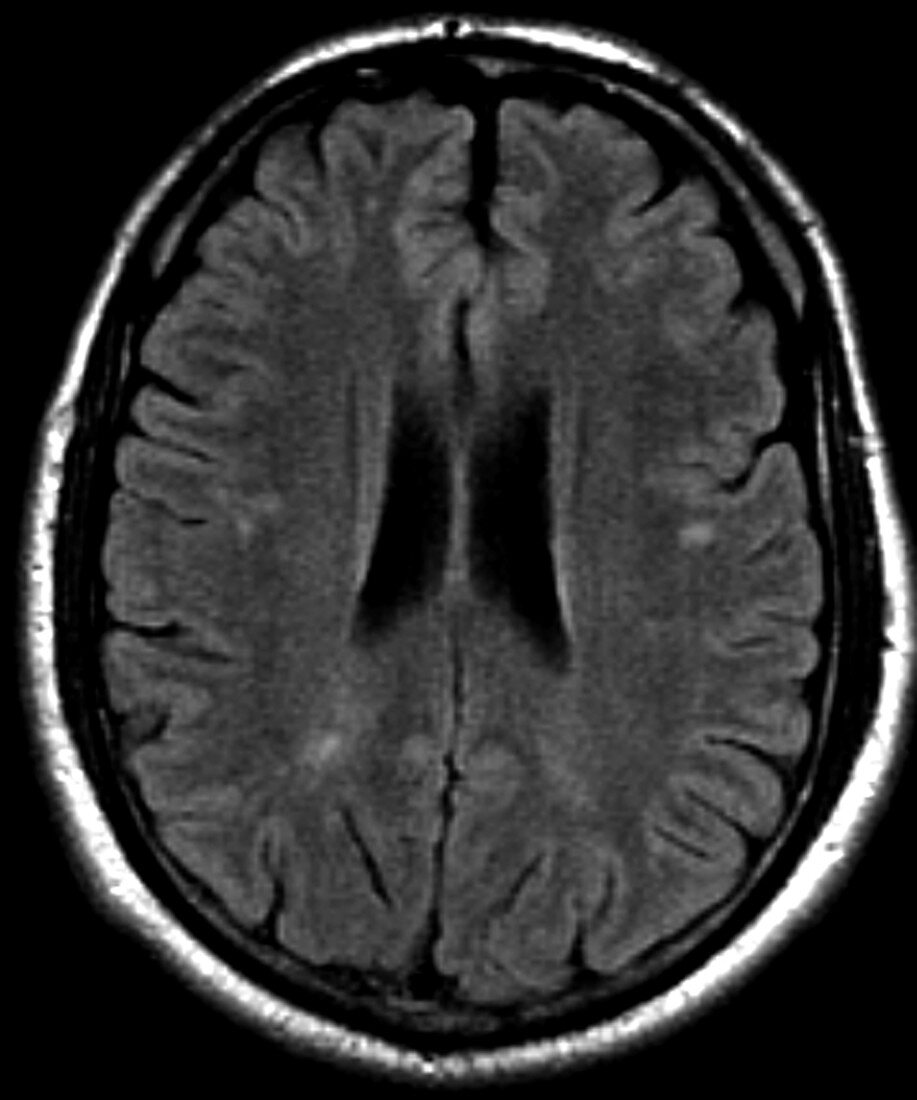 Migraine, MRI