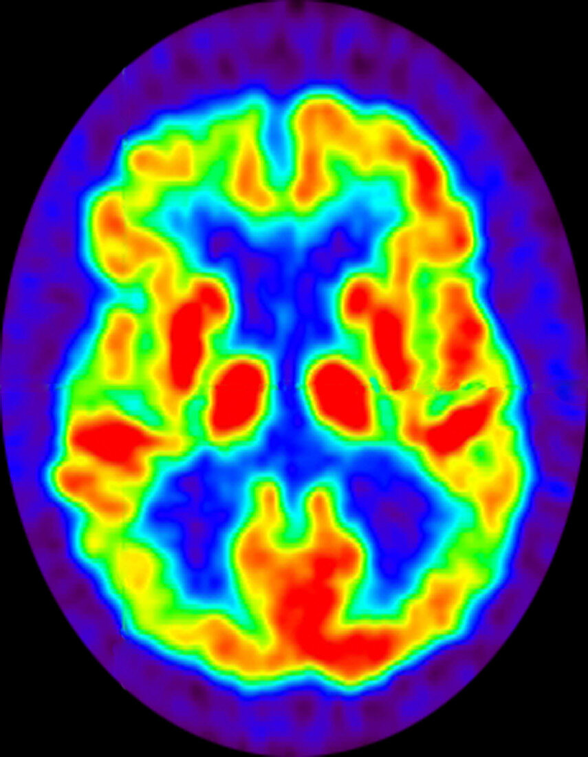 Alzheimer's, PET scan