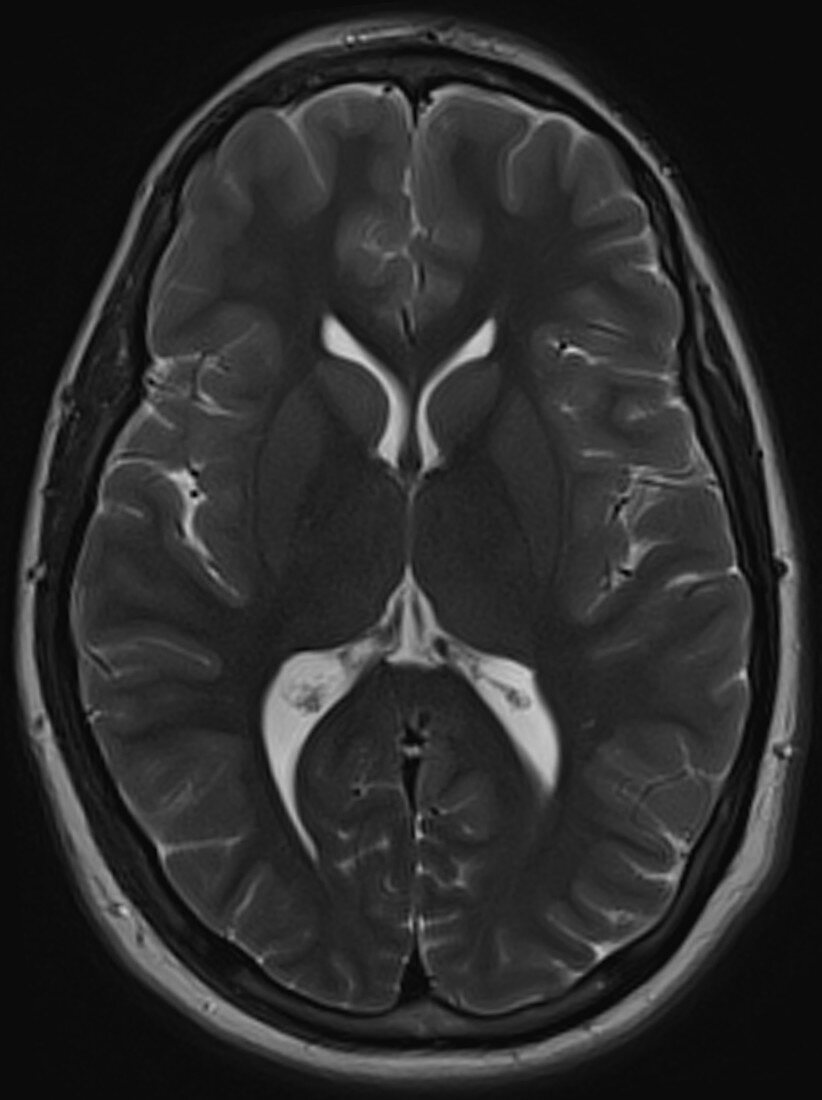 Normal brain, MRI