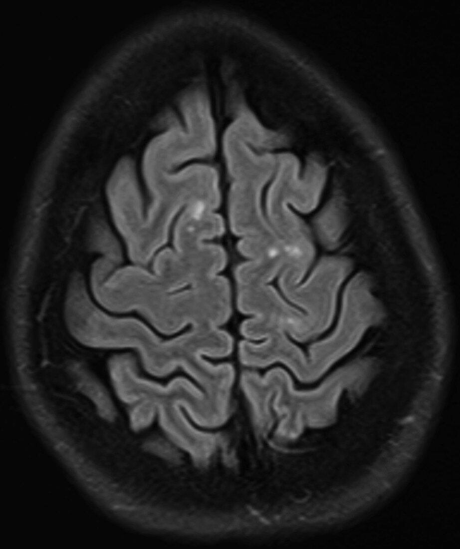 Multiple sclerosis, MRI