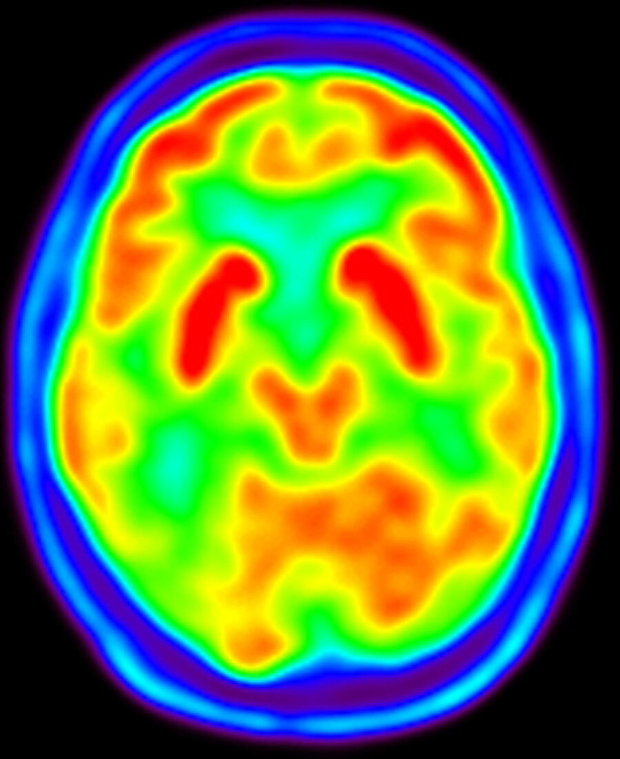 Normal brain, PET scan