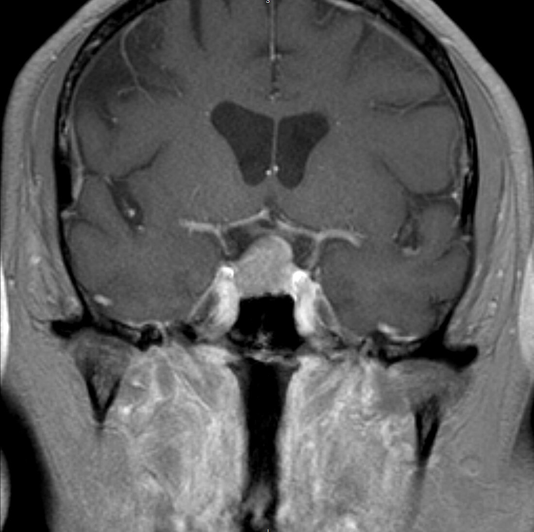 Pituitary macroadenoma, MRI