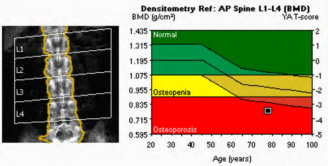 Osteoporosis, X-ray bone densitometry