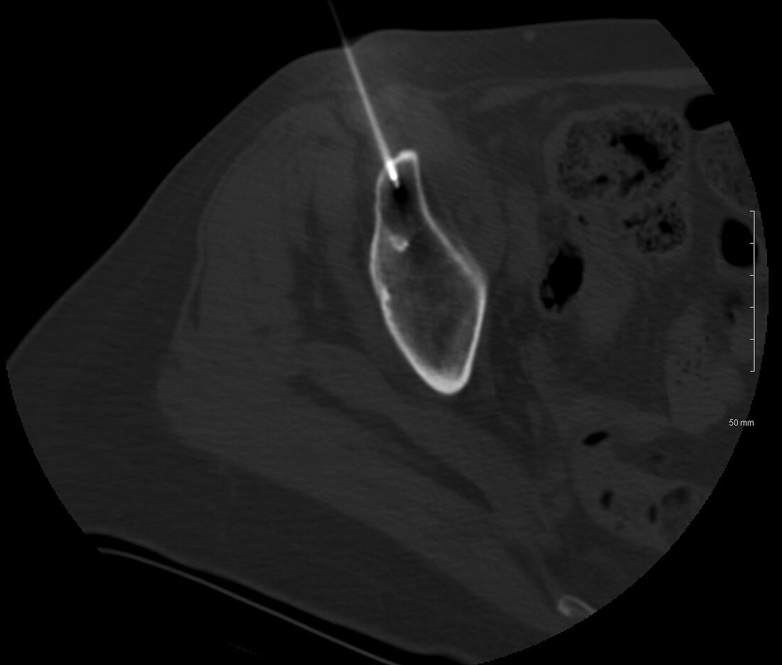 Metastasis in hip, CT scan