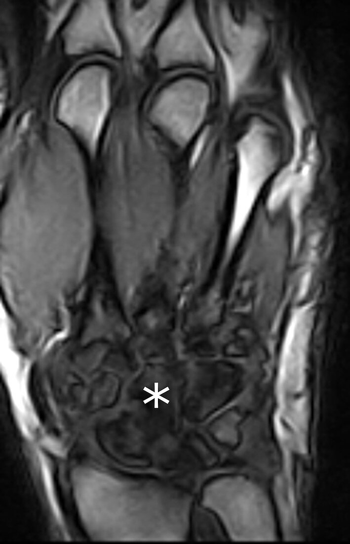 Bone marrow edema osteitis, MRI