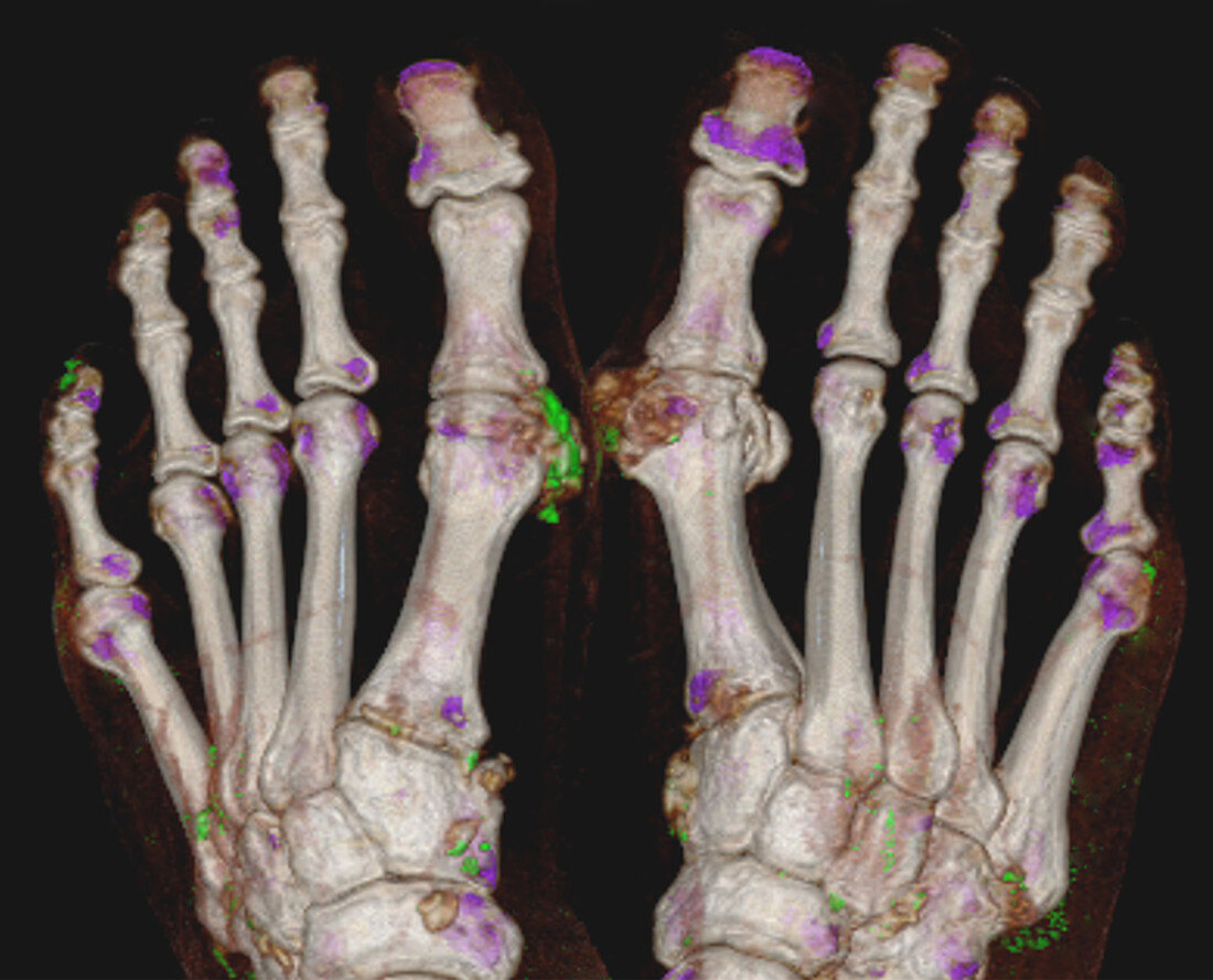 Gout, 3D CT scan