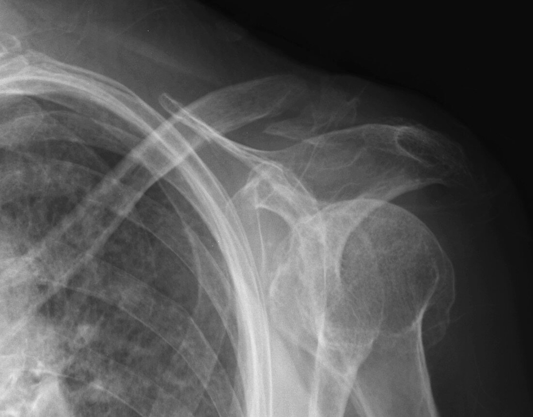 Distal clavicle fracture, X-ray
