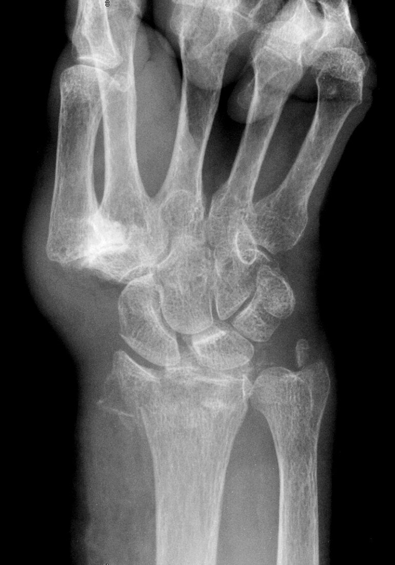 Wrist fracture, X-ray