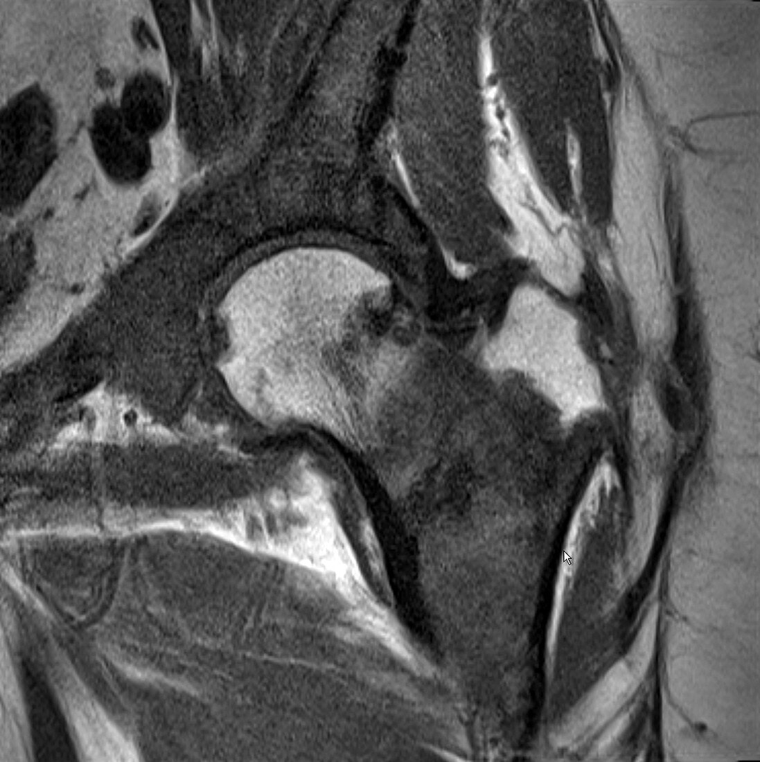 Metastases in hip, MRI
