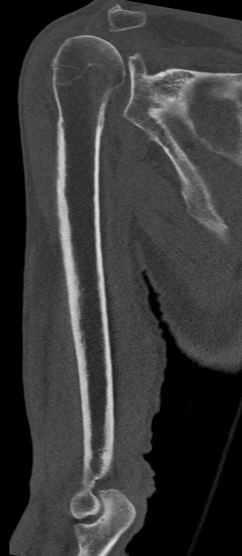 Normal humerus, CT scan