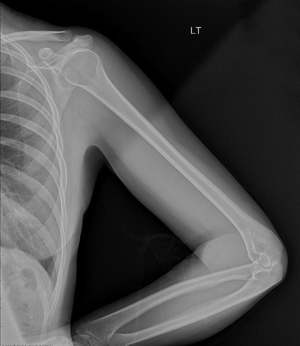 Normal humerus, X-ray