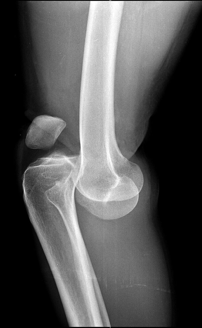 Knee Dislocation, X-ray