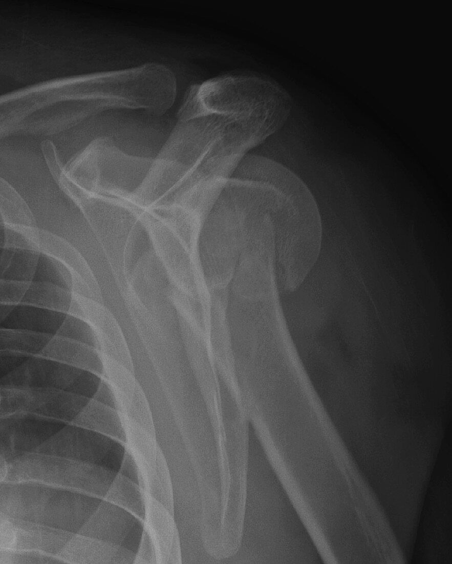 Fractured humerus subluxation of humeral head, X-ray