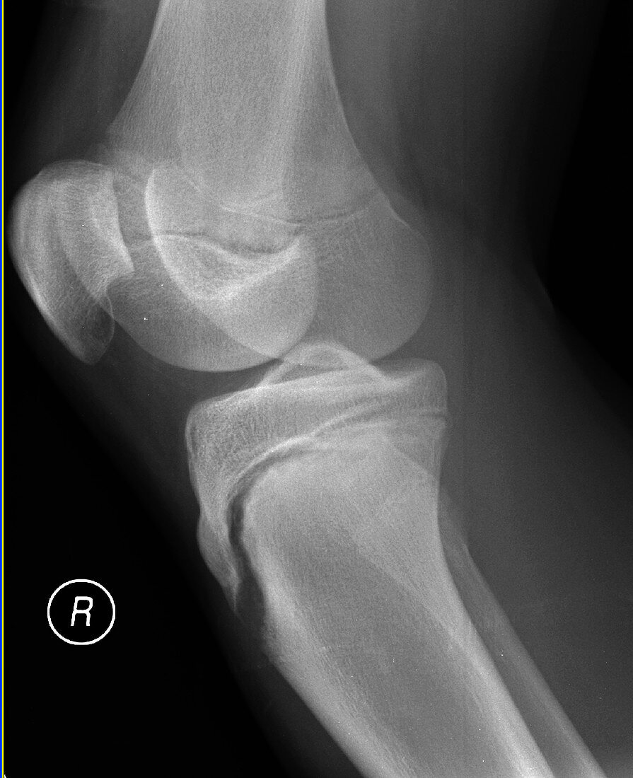 Salter-Harris fracture, X-ray