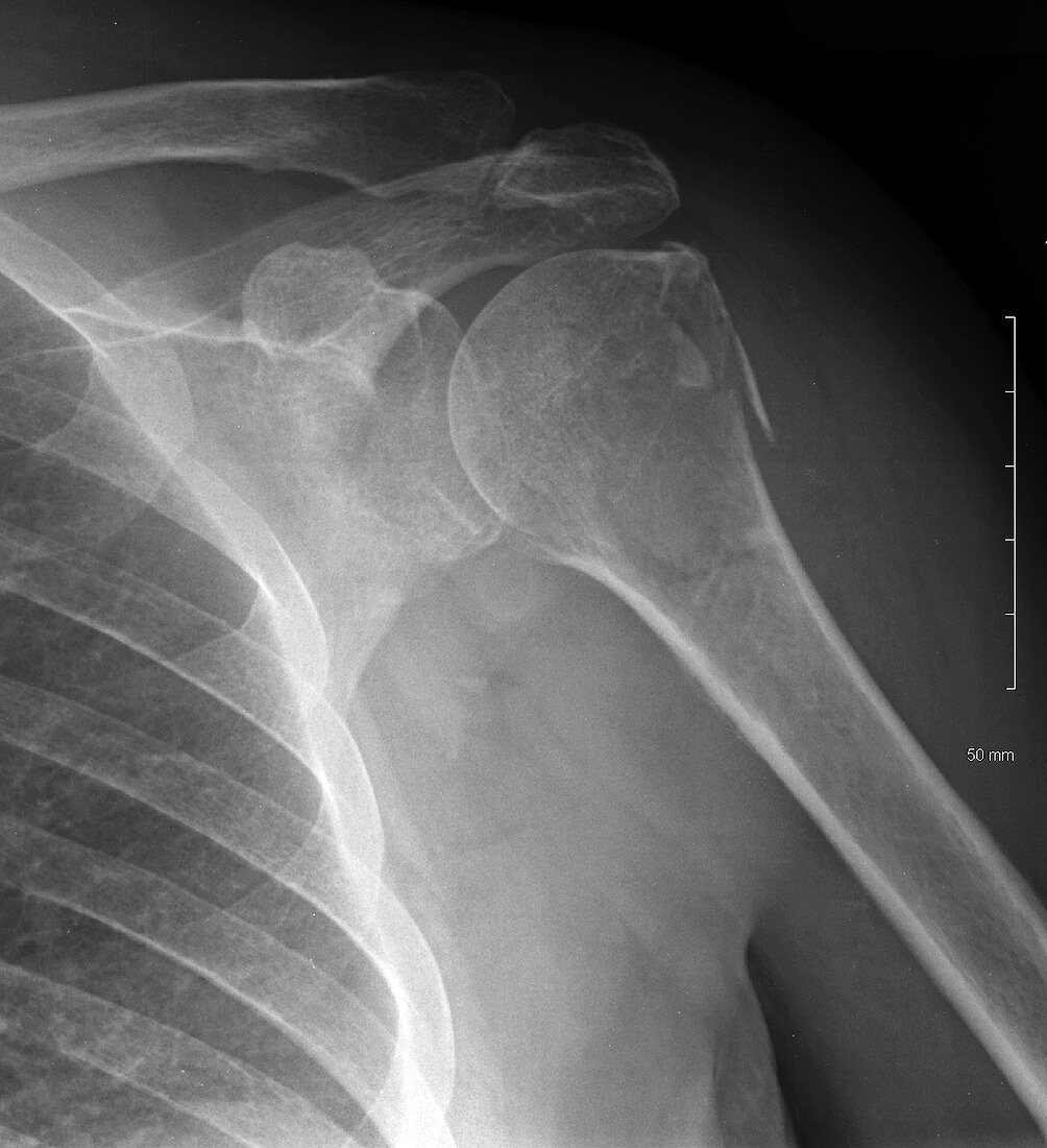 Shoulder fracture, X-ray