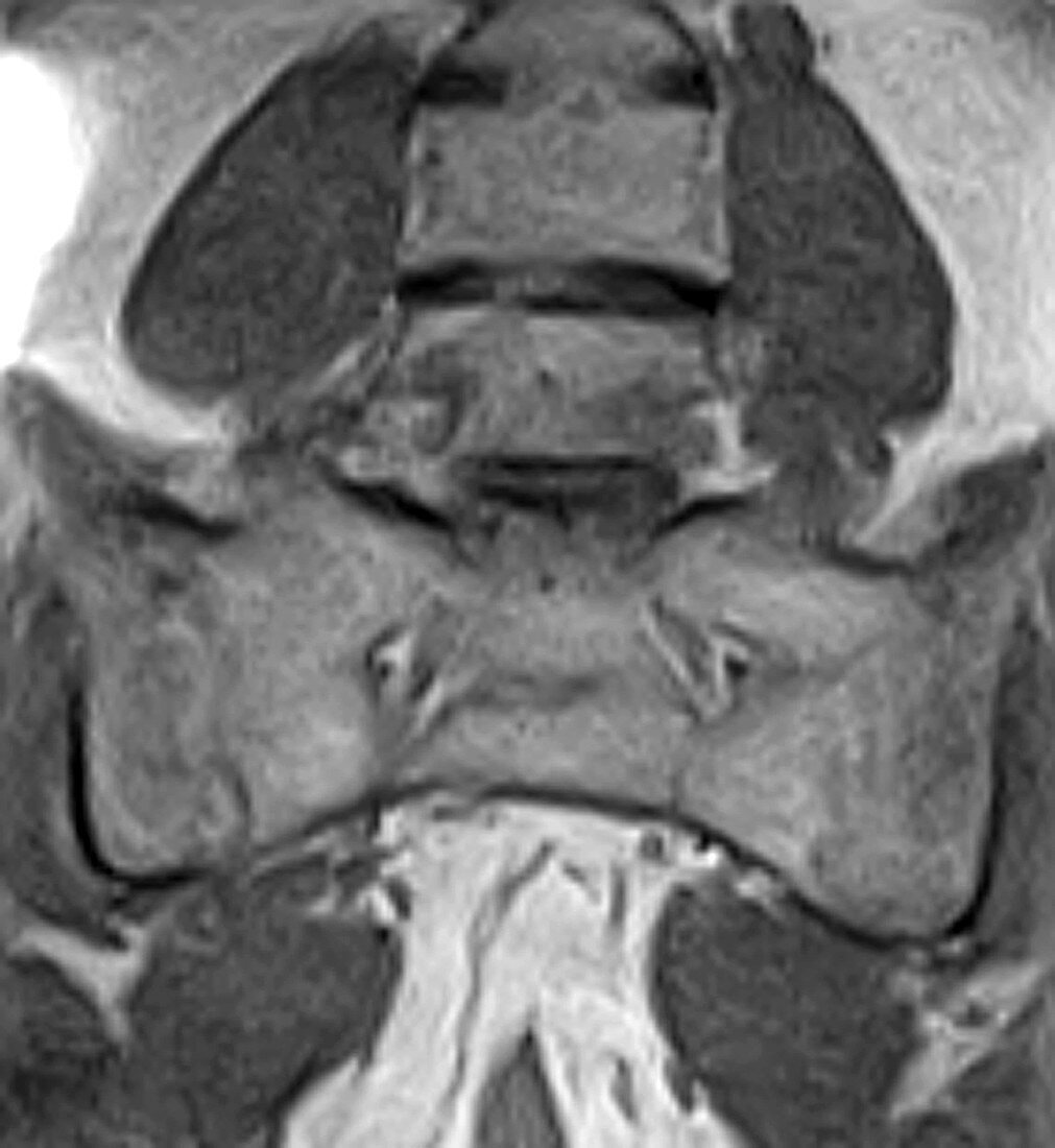 Ankylosing spondylitis, MRI