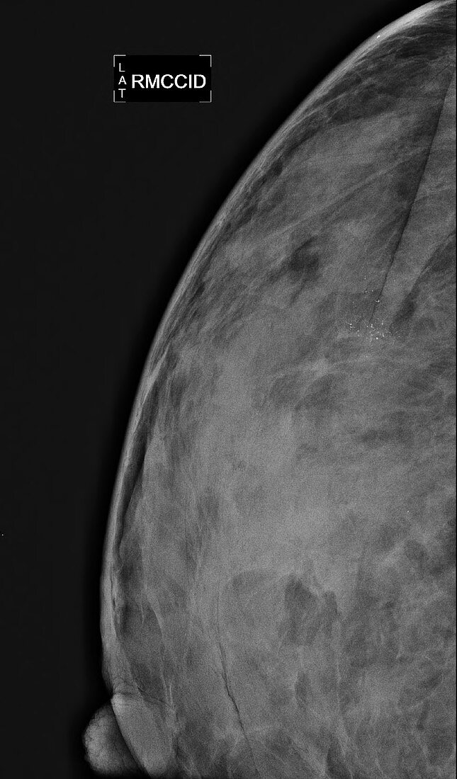 Breast cancer, mammogram