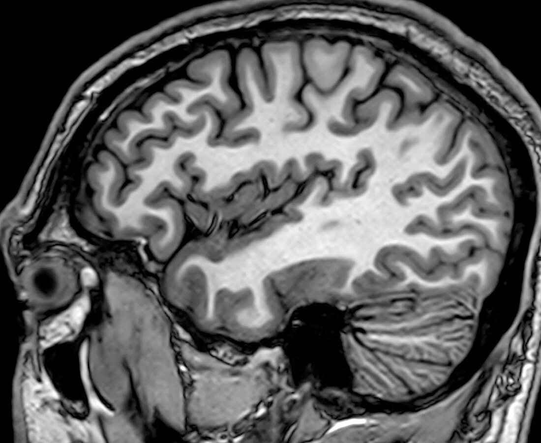 Normal Sagittal T1 MRI Brain 3