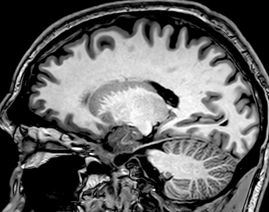 Normal Sagittal T1 MRI Brain 7