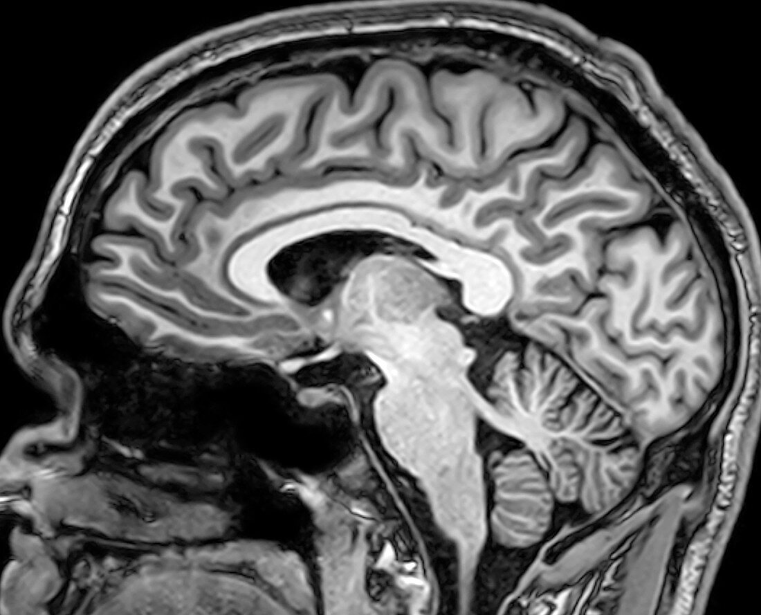 Normal Sagittal T1 MRI Brain 9
