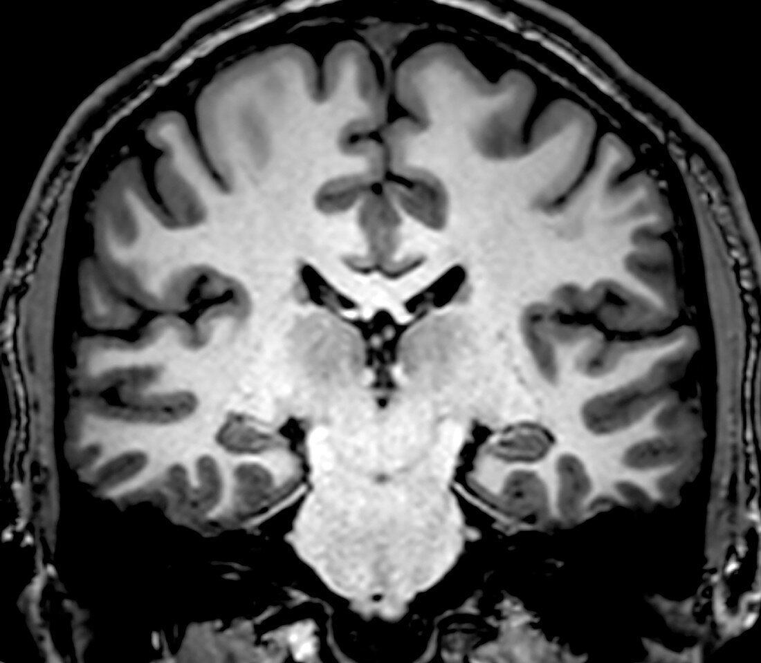 Normal Coronal T1 Brain