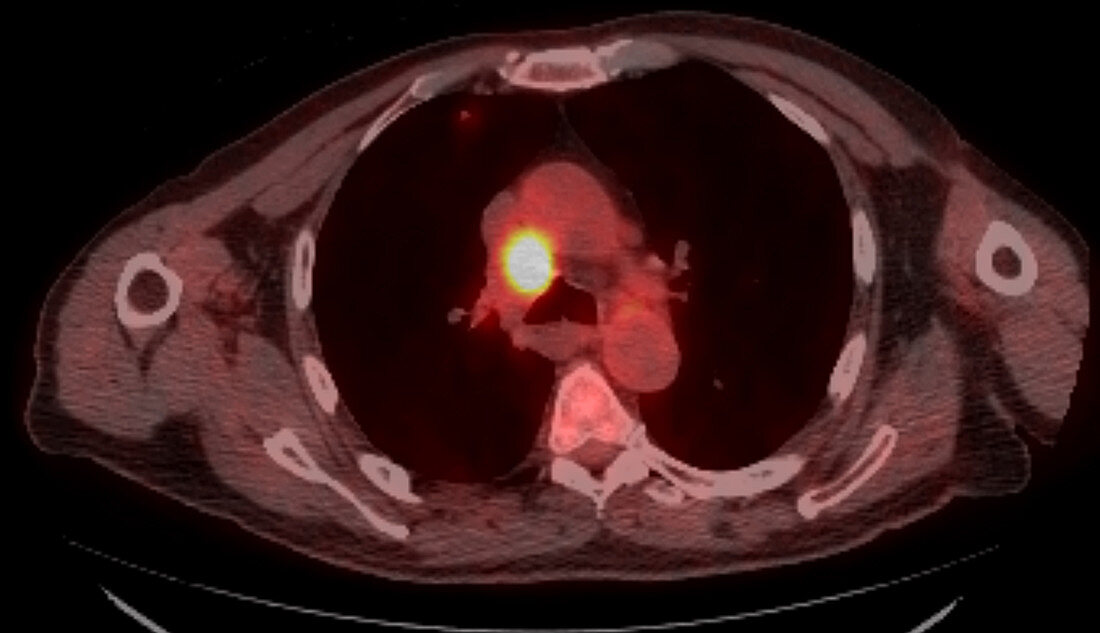 Metastatic renal carcinoma, CT scan