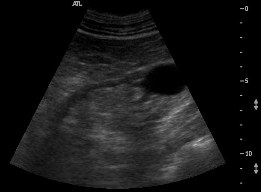 Chronic renal failure, Ultrasound