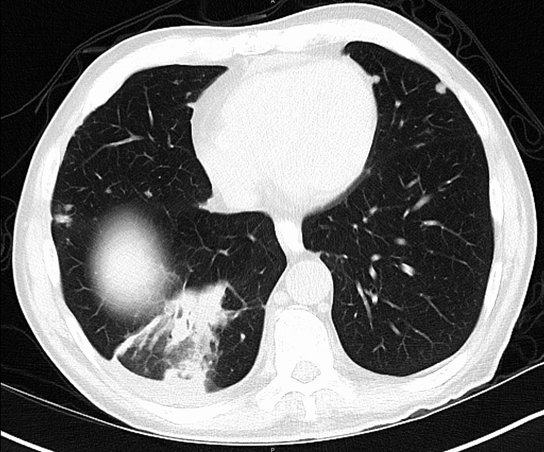 Metastatic renal carcinoma, lungs, CT scan