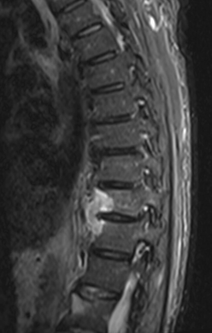 Metastatic renal carcinoma, spine, MRI